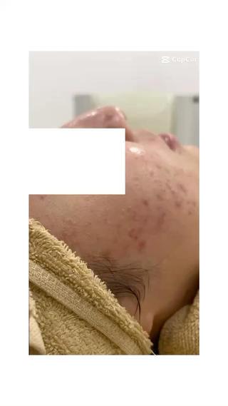 繰り返しニキビ改善
継続6回