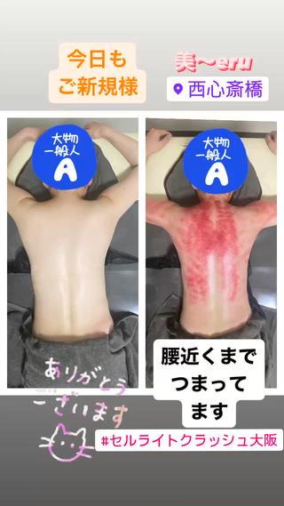 肩凝りガチガチの方
赤みが出てきます!!
腰辺りまで赤みが出ます
めちゃくちゃ痛いですけど、終わるとスッキリ