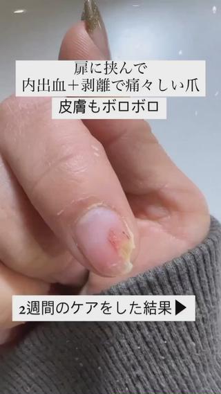 #自爪育成
#深爪
#薄爪
#男爪
#剥離
#貝爪