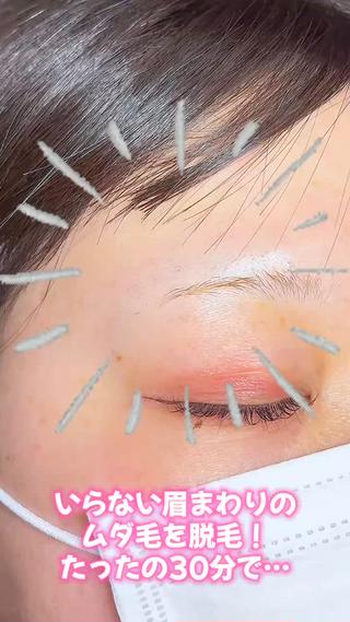 女性 眉まわりの脱毛 美容電気脱毛(ニードル脱毛)