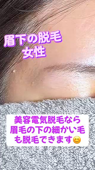 眉下の脱毛 女性 美容電気脱毛(ニードル脱毛)
