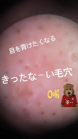 毛穴はケアしないと、どんどん広がるばかりか、毛穴の周りがシミになってしまいますそうなったら、何しても目立ちます早めのケアをおすすめします