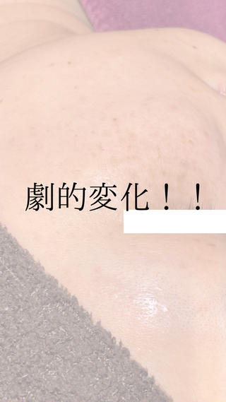 シミの緩和ケア最強の1番人気の組合せ!!ハーブとシミケアで劇的変化︎
2022年10月→シミケアデトックススタート2023年3月→ハーブ+シミケアスタート
ビフォーは現在7月のお写真ですが劇的にお肌変わってますよね
お肌が白く、シミも薄く、お肌の水分量も上がってキメも整っています
お写真のご協力ありがとうございます。
ここまでお肌が変わってきたのはお客様の努力の結果でもあります。
効果の出方には個人差がありますがお手入れ後のお肌にどんな物を使用するか食・生活習慣などどう過ごされるかでも改善のスピードに違いがあります。
ご自身でのケアをおろそかにしてしまうと結果に繋がるのも遅く効果を持続することが出来ずにサロンでのケアも無かったことにしてしまいます。
4tune.ではこの先も悩まなくても良いお肌作り根本からの改善をお客様と二人三脚で目指しています。
その為4tune.では毎回お肌の変化、肌、体の調子などお伺いしながら必要なアドバイスなどさせて頂いています。
一時的なケアではなくて
この先も悩まなくてもいいお肌作りを
一緒にしていきませんか?