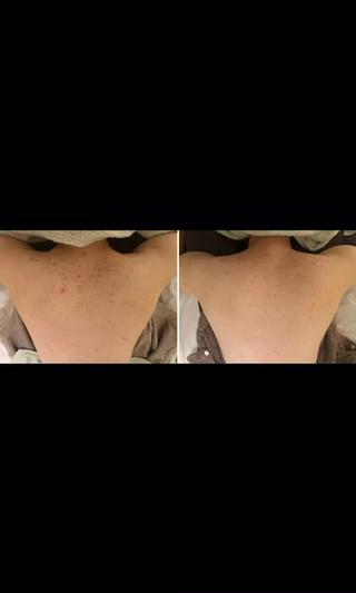 赤いニキビにはこれ
《CHRISTINA コモデックス》
赤いニキビ/赤み/ゴワつき/肌の凹凸などでお悩みのトラブルにはこのメニューにてご予約くださいませ。
お顔のみでなく背中やデコルテのお悩みにも。
※ボディは女性限定
=============
KALANCHOE
中目黒駅徒歩3分
【営業時間】
月~金/09:30~21:00
土日祝/11:00~20:00
=============
どんなお肌悩みもご相談くださいませ
2回目以降も続けやすい特典あり
・ニキビケア/跡/凸凹改善
・乾燥/ゴワつき/ザラつき
・毛穴全般
・くすみなど
その他
