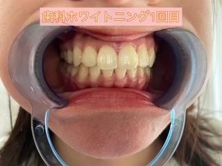 東区香椎歯のセルフホ ワイトニングGLOWのその他イメージ