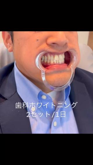 東区香椎歯のセルフホ ワイトニングGLOWのその他イメージ