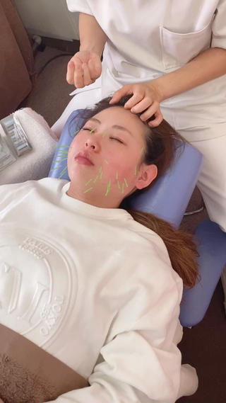 美容鍼施術♡