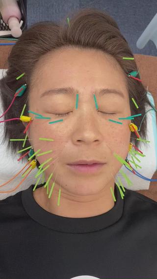 美容鍼灸施術での通電した時の動画です
患者様によってアプローチする場所も違ってはきますが、筋肉にまでさして通電するので表情筋が勝手に動きます