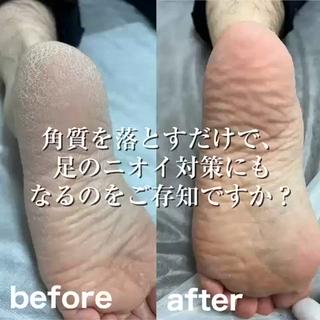 「角質を落とすだけで、足のニオイ対策にもなるのをご存知ですか？」

夏は足元のニオイやムレも気になる季節…。

実は、ニオイの原因のひとつが古い角質なんです！
放っておくと雑菌がたまり、ニオイや肌荒れのもとに。

角質ケアで、足元すっきり＆爽やかに

7月限定の角質ケアキャンペーン実施中
かかと・足裏がふわふわで見た目もアップ

ぜひこの機会に体験してみてください♪ 