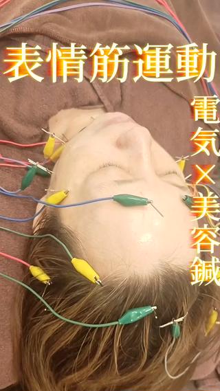 美容鍼
