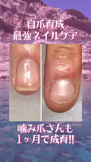 噛み爪さんもおまかせください!!
あなたの長年のお悩み、
たった3ヶ月で解決しませんか?
✺自爪育成最強ケア
第二弾モニター様は満席となりました!
第三弾モニター様、𝟑名限定先着順で募集いたします!
✪𝟑ヶ月間 サロン施術𝟖〜𝟏𝟎回・カウンセリング・施術後の経過写真コラージュプレゼント・育成オイル含むホームケア用品込
¥𝟔𝟕,𝟐𝟎𝟎(税込)¥𝟓𝟓,𝟎𝟎𝟎(税込)
残席名様となりました!
既に複数お問い合わせ頂いておりますので、
気になられている方はお早目にご連絡くださいませ!
ご予約、お問い合わせは
公式𝐋𝐈𝐍𝐄から
お願い致します
@𝟎𝟒𝟑𝐨𝐜𝐦𝐟𝐚
༶
お友達追加後、
ご質問内容を
メッセージにてお送りくださいませ
確認できましたら
折り返しご連絡させて頂きます
༶
༶
༶
𝐉𝐑京都線 千里丘駅から徒歩𝟐分
【最強ネイルケア&手の病院サロン取扱店】
自爪で過ごされるお客様を、健康なお爪・手肌に導くサポートを行って参ります
𓇠𓇠𓇠𓇠𓇠𓇠𓇠𓇠𓇠𓇠𓇠𓇠𓇠𓇠𓇠
𝐩𝐫𝐢𝐯𝐚𝐭𝐞 𝐧𝐚𝐢𝐥 𝐬𝐚𝐥𝐨𝐧 𝐏𝐚𝐮𝐬𝐞(ポーズ)
〒𝟓𝟔𝟔-𝟎𝟎𝟏𝟏
大阪府摂津市千里丘東𝟑-𝟏𝟎-𝟏𝟓 西村ビル𝟑𝟎𝟏号
(𝟏階に鳥貴族さんのあるビルの𝟑階です️)
月・水・金・日・祝
→𝟏𝟎:𝟎𝟎〜𝟐𝟐:𝟎𝟎(最終受付𝟏𝟗:𝟎𝟎)
火・木→定休日
𓇠𓇠𓇠𓇠𓇠𓇠𓇠𓇠𓇠𓇠𓇠𓇠𓇠𓇠𓇠