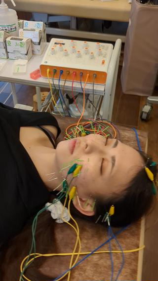アゴの下のたるみを引き上げ、フェイスラインをシャープにするために、咬筋、側頭筋、前頭筋、笑った時の表情の印象を軟らかくするために、大頬骨筋に鍼通電。