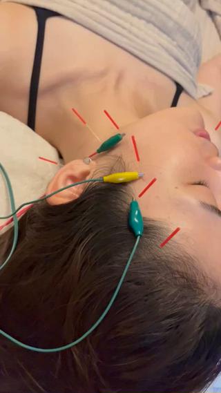 美容鍼鍼通電 