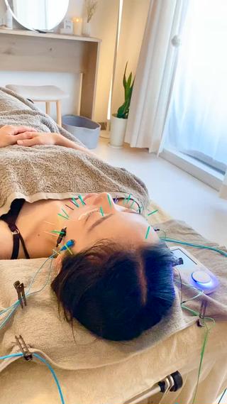 美容鍼
自己治癒力によって、お肌活性化
美容外科と違って切ったり、入れたりしないので安心♡
ナチュラルにリフトアップ