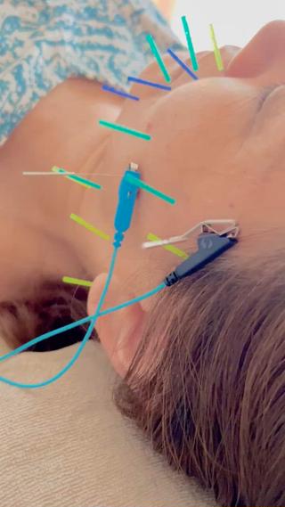 美容鍼
電気を流して硬くなった筋肉をほぐして、
リフトアップするように動かします
ぴくぴくと心地良く動かされるので、
一度体験すると癖になります