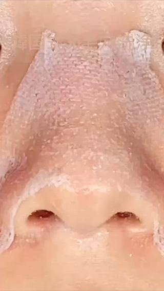 韓国式3D毛穴洗浄
顔の中心のお鼻を綺麗にしましょう