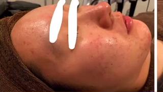 ハーブピーリング、before after動画
写真より、もっともっとbefore afterが
分かりやすいので、ぜひぜひご覧あれー
ディープクレンジング→濃密泡洗顔→ホットタオル→毛穴吸引→ハーブ導入→保湿+鎮静パック→お仕上げ、、、