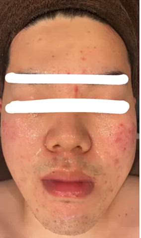 メンズも大歓迎です
ハーブピーリング、before after動画
写真より、もっともっとbefore afterが
分かりやすいので、ぜひぜひご覧あれ
ディープクレンジング→濃密泡洗顔→ホットタオル→毛穴吸引→ハーブ導入→保湿+鎮静パック→お仕上げ、、、