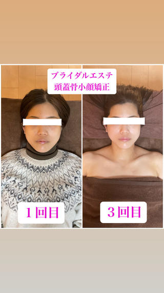 ブライダルエステで骨格姿勢矯正･筋膜オイルマッサージ･頭蓋骨小顔矯正を受けていただきました

姿勢と重心が変わるだけでも見え方が変わり、
そこから筋膜オイルマッサージで痩身、
さらに頭蓋骨と顔を矯正して小顔＋肌ツヤアップ

姿勢矯正･美容整体と痩身エステを同時に受けられるプライベートサロンです

ブライダルエステをご検討中の方はチェックしてみてください

======================================

〒542-0086 
大阪市中央区西心斎橋2丁目10-13クリスタルエグゼ心斎橋501号室
Apple 心斎橋 近く
 