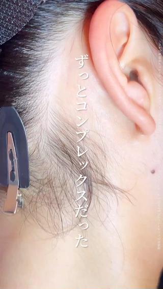 うなじの“くるん毛”がずっと気になっていた
自分では見えないのに、
なぜか気になるうなじ。
特に癖毛やうねりのある方にとっては、
毛先がくるんと浮いてしまうのが悩みの種に…。
実はこのお悩み、
意外と多いんです。
シュガーリングで根本から整えることで、
“見た目も肌触りもスッキリ”が即実感。
あの「くるん」がなくなるだけで、
首まわりの印象がガラッと変わります。
しかも毛質が変わってくるから、
次に生えてくるときも楽。
まとめ髪をした時に自信が持てる
後ろ姿がスッキリして見える
癖毛特有の悩みが軽くなる