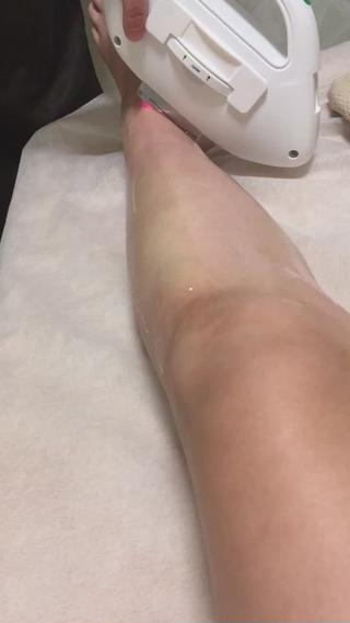 美肌脱毛 