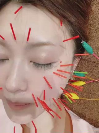 美顔ケア
美容鍼を多数アプローチし肌の新陳代謝(ターンオーバー)を促進させ肌質改善とリフトアップケアを行います