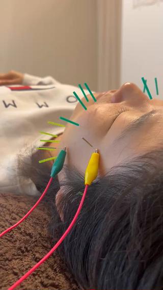 皆様の悩みに合わせて鍼の場所変えてます