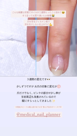 自爪育成のお客様です
3週間後の比較なのでまだ劇的な変化はないですが
ちょこっとずつ改善してます
少しでも自爪にコンプレックスや悩みがある方
是非是非お問い合わせください...♪*゚
Instagram ▷︎ @__azum1