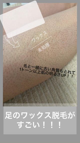 足のワックス脱毛 