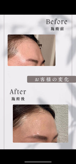 脂肪増強ヒアルリッチファット♡
ダウンタイムなしで立体おでこが叶う。
ヒアルロン酸・脂肪 注入不要