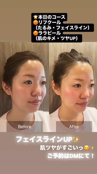 コアラル独自開発美容機器
︎リフクール︎

むくみ、たるみ改善、小顔、くすみ、ハリ，首肩、ハイフの最新版、ラジオ派で熱、むくみ顎下
が気になる方是非体験してみてください

痛みゼロでダウンタイムもございません 