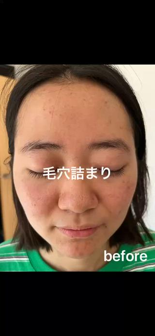 毛穴詰まりを解消しましょう