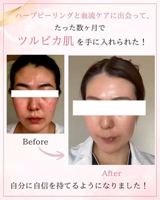 5年以上ニキビに悩んだ私が辿り着いた、ニキビ改善ケア
私のように、お金と時間を無駄にする必要はありません!
ニキビに悩んでいる方に、最短で改善できるケアが当サロンにはあります