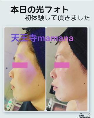 1番人気は光フォト！


クレンジング
光フォト
マッサージ　
パック
スチーム。。。

ご来店頂いた時　

帰られる時の変化がダントツの

mamanaの光フォトは　

1番人気　

通って頂くと　

小顔
美肌
美白

シミが薄くなり

ハリがアップし

透明感が増して。。。

たるみもキュッ　

私もちょいちょいお世話になっています笑　

鼻が高くなるケースが多い。。

マッサージ効果も相まって効果↑ 

2日目くらいからがさらにいい感じ

脱毛を卒業したら　通いますと言って頂けました♪

そんなお客様も多いメニューです(*^^*) 

ウトウトしている間に　

引き上げ
モチモチ。。。

オススメです

#光フォト
#光フォトフェイシャル
#天王寺エステ
#光フォト人気
#小顔
#美白
 