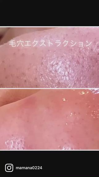 毛穴ケアなのに　全顔エステ&小顔も叶うキャンペーン中 
