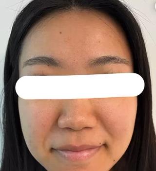 ハーブピーリングモニター様5回施術。
コメドのようなものができていて肌触りざらつき感ありましたが、施術後肌が滑らかになり、好転反応で施術後何度かニキビが出ましたがすぐ治ります