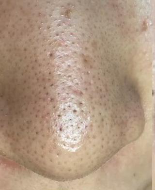 毛穴一つ一つ丁寧に圧出していくので、一回でも驚く変化