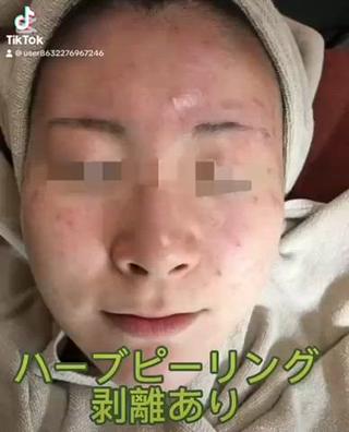 こちらのお客様は顔全体のニキビニキビ跡と少しアトピー肌にお悩みでしたが、施術4回で見違えるほど、綺麗になられております日々のホームケアはもちろん大事ですので、できる限りのアドバイスはさせていただきます️ 