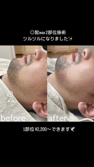 メンズ専用!!
髭ワックス動画です
髭は1番濃く太い毛になるので、
眉毛に比べると痛みが強くなります
ですが、
何より毎日剃る必要がなくなる!
青髭解消!清潔感UP!するので
一度された方は続けられる方が多いです♪
当店は、髭Wax一部位¥2200!
部位毎の料金になっておりますので
したい部分だけできる◎
※ハイドロジェリー鎮静パックは
+¥1000になりますが、
一緒につけられることをオススメします!