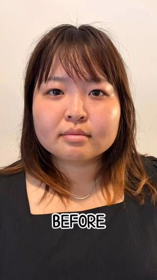 ハーブピーリング、ここまで変わる。
「え、同じ人の…?」
そう思った方へ。
これ、加工でも別人でもありません。
ハーブピーリング1回のBefore→After。
肌のトーン、質感、毛穴の見え方まで、
ここまで変化することがあります。
もちろん、すべての方が同じように
変化するわけではありません。
でも、
「何をしても肌が変わらない」
「もう年齢的に仕方ない」
そうやって諦めるには、まだ早い。
肌は、ちゃんと向き合えば変わっていく。
だからこそ、
その場しのぎのケアではなく、
肌質そのものを整えたい方へ。
このBefore→Afterに衝撃を受けた方。
次は、あなたの肌で。