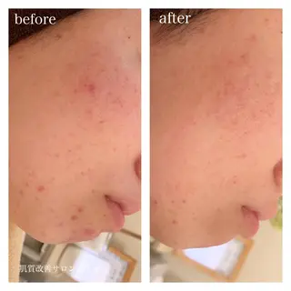 セミロング カラー パーマ ヘアアレンジ メンズ キッズ ネイル マツエク・マツパ ニキビ跡専門サロン Ainaのエステ・リラクイメージ