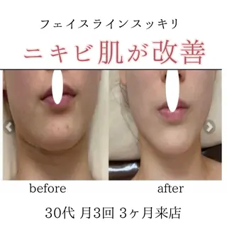 シミニキビ改善 小顔サロンのエステ・リラクイメージ