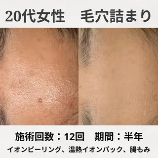 ニキビ跡改善専門🔥 医療にはできない改善のエステ・リラクイメージ