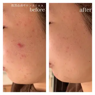 セミロング カラー パーマ ヘアアレンジ メンズ キッズ ネイル マツエク・マツパ ニキビ跡専門サロン Ainaのエステ・リラクイメージ