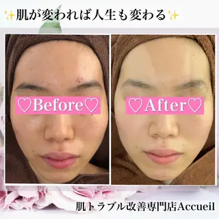 ミディアム カラー パーマ ヘアアレンジ メンズ キッズ ネイル マツエク・マツパ アイブロウ ニキビ・肌質改善専門 ♡人生が変わるサロンのエステ・リラクイメージ