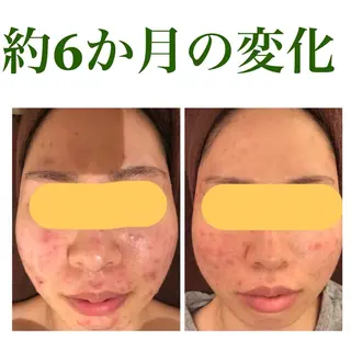 ミディアム カラー パーマ ヘアアレンジ メンズ ネイル マツエク・マツパ ニキビ・肌質改善専門 ♡人生が変わるサロンのエステ・リラクイメージ
