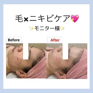 🌷MURA 毛穴・顔脱毛🌷のエステ・リラクイメージ