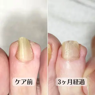 ネイル 巻き爪・肥厚爪ケア 専門サンセリテのネイルデザイン