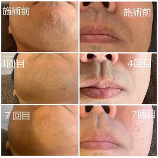 脱毛 yukinoのエステ・リラクイメージ