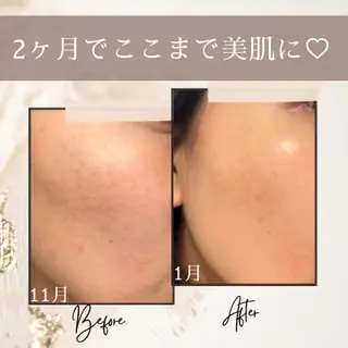 《美肌・小顔》美容鍼 &マッサージ*MEIのエステ・リラクイメージ